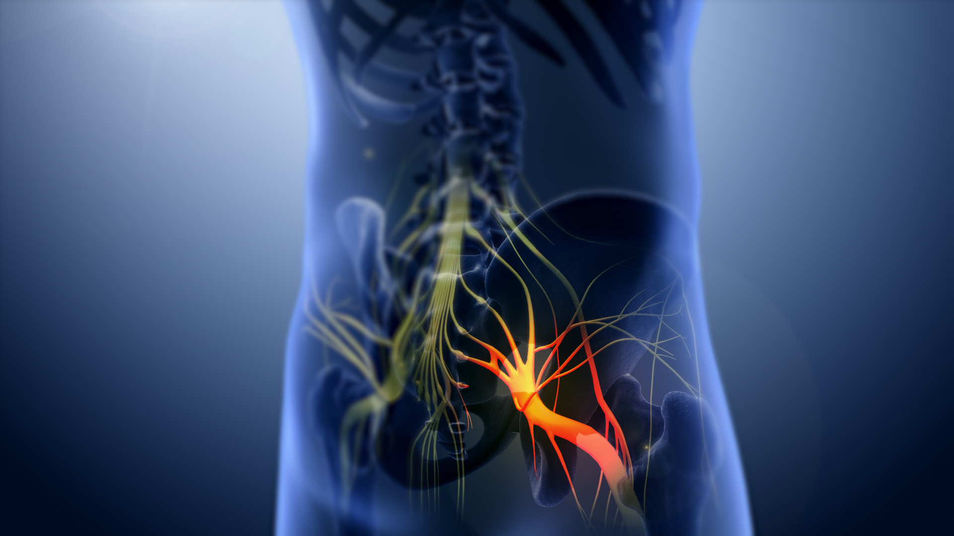 sciatic nerve pain and inflammation 3D Image