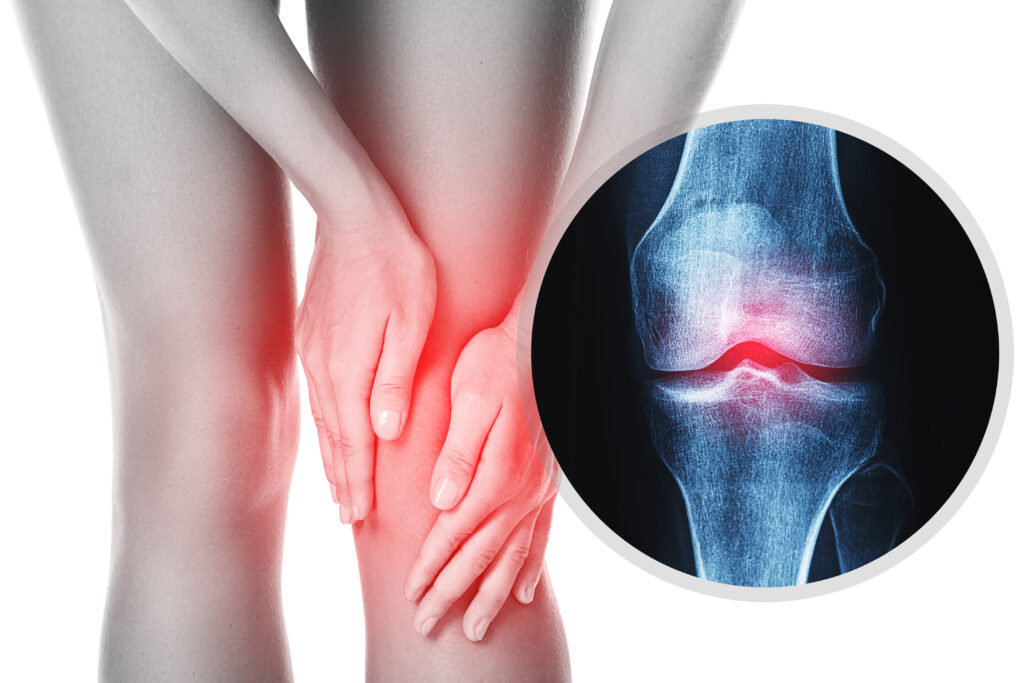 Osteoarthritis and joint pain - Boost Physiotherapy