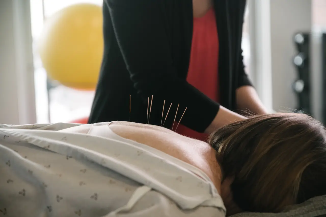 Acupuncture