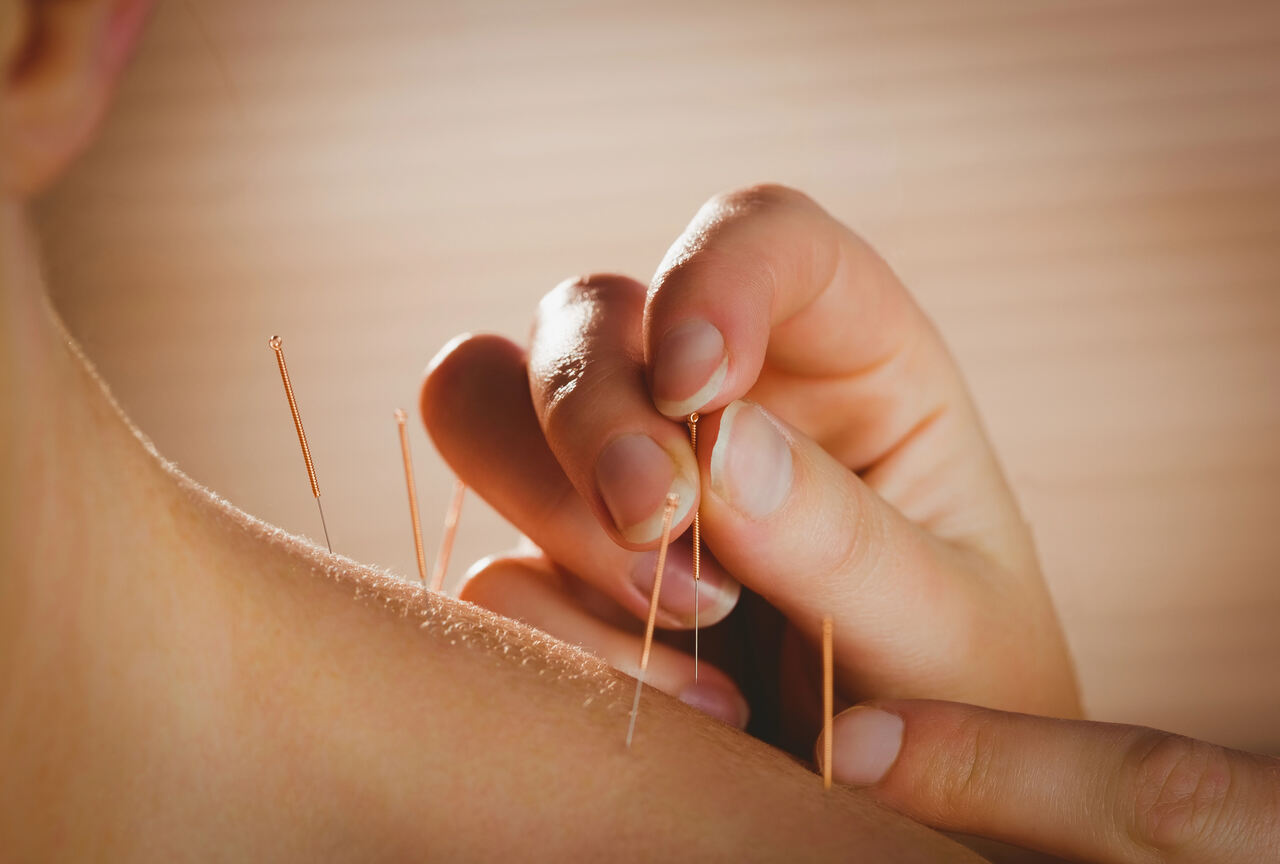 dry needling for muscle knots edmonton