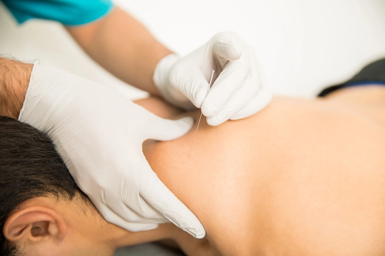 benefits of dry needling edmonton