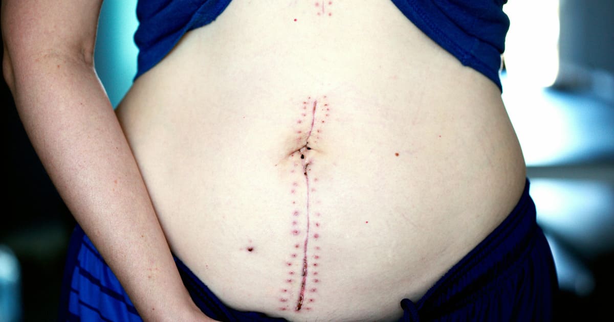 C-section scar
